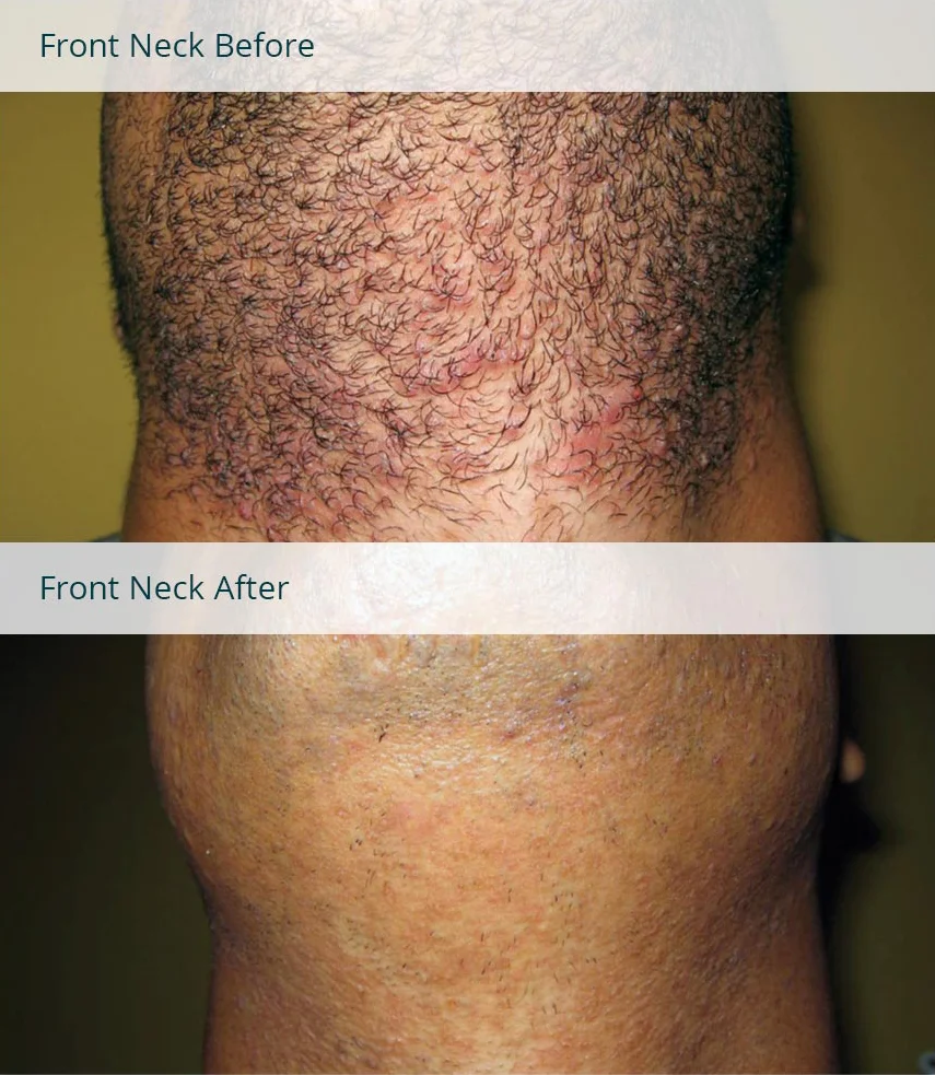 FrontNeck Laser Hair Removal Photo, Before & After