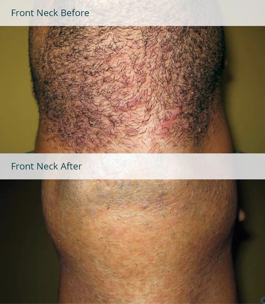 Above/below stacked image depicting a man looking upward after getting laser hair removal on his front neck to showcase the before/after neck laser hair removal results