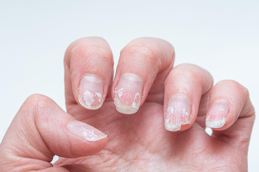 understanding-nail-damage-as-a-structural-issue