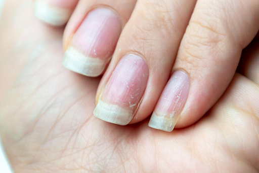 how-damaged-nails-affect-nail-art-performance