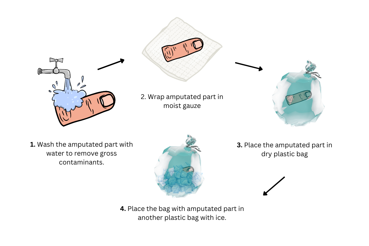 Steps to be taken to preserve amputated finger