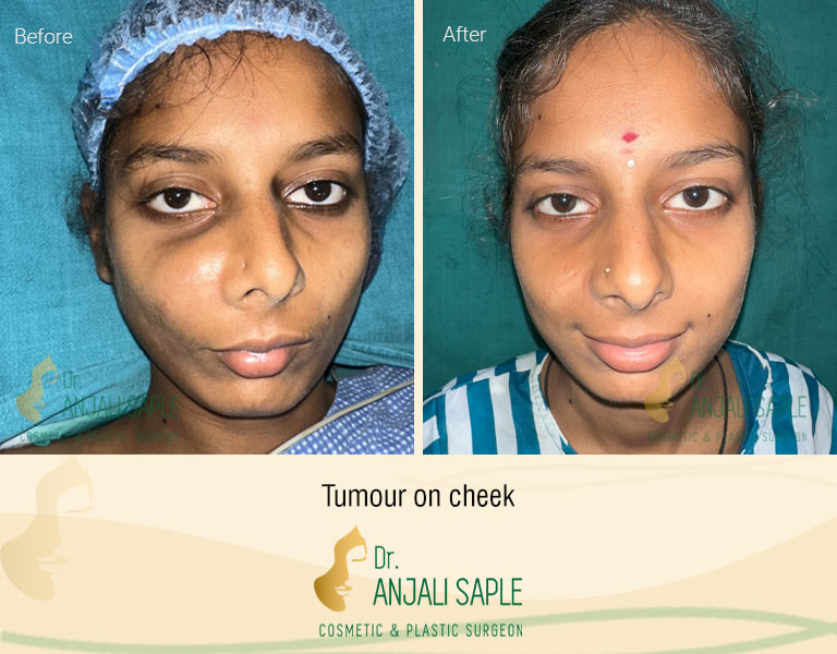 Swati with tumour on her cheek before and after images