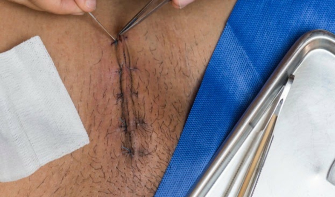 hernia surgery,Reasons not to delay Hernia Surgery