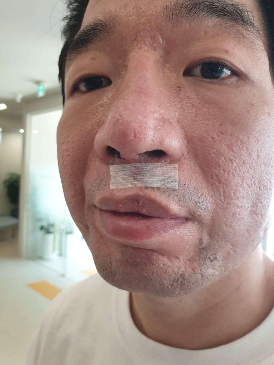 Close-up of Steven with tape under his nose during his recovery