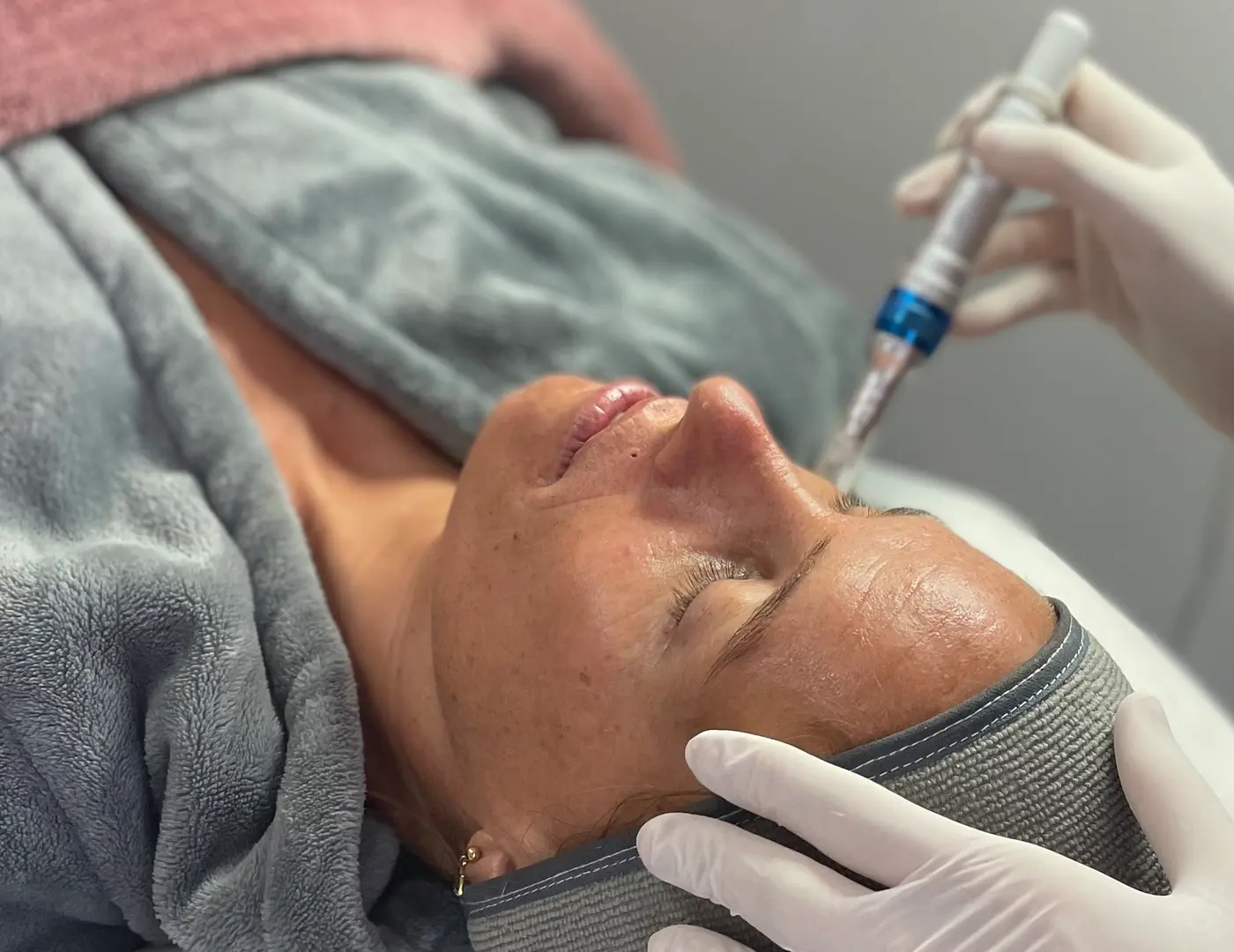 Dermapen (Microneedling)