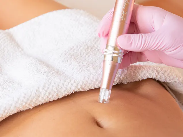 Dermapen corporal (Microneedling)