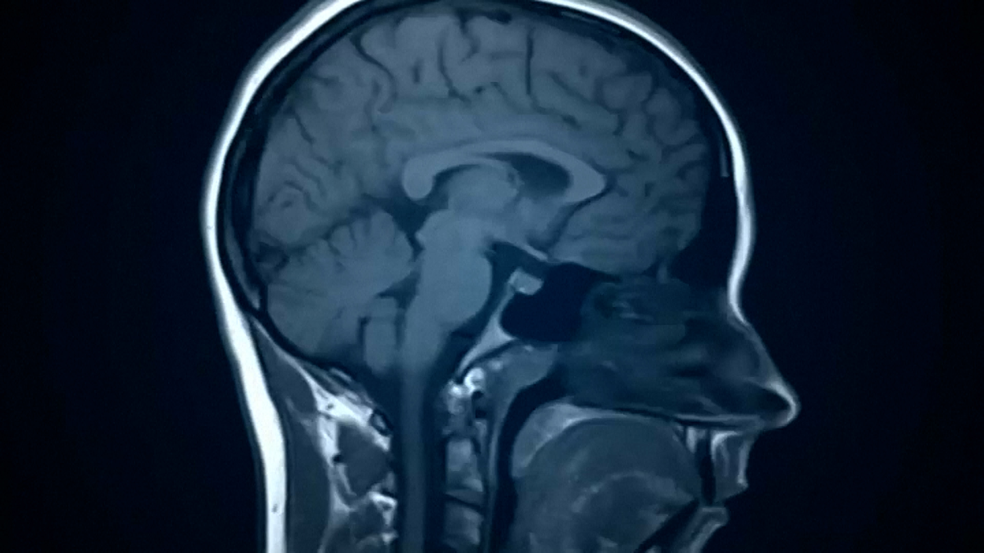 Music Listening Linked to Lower Dementia Risk, Study Finds