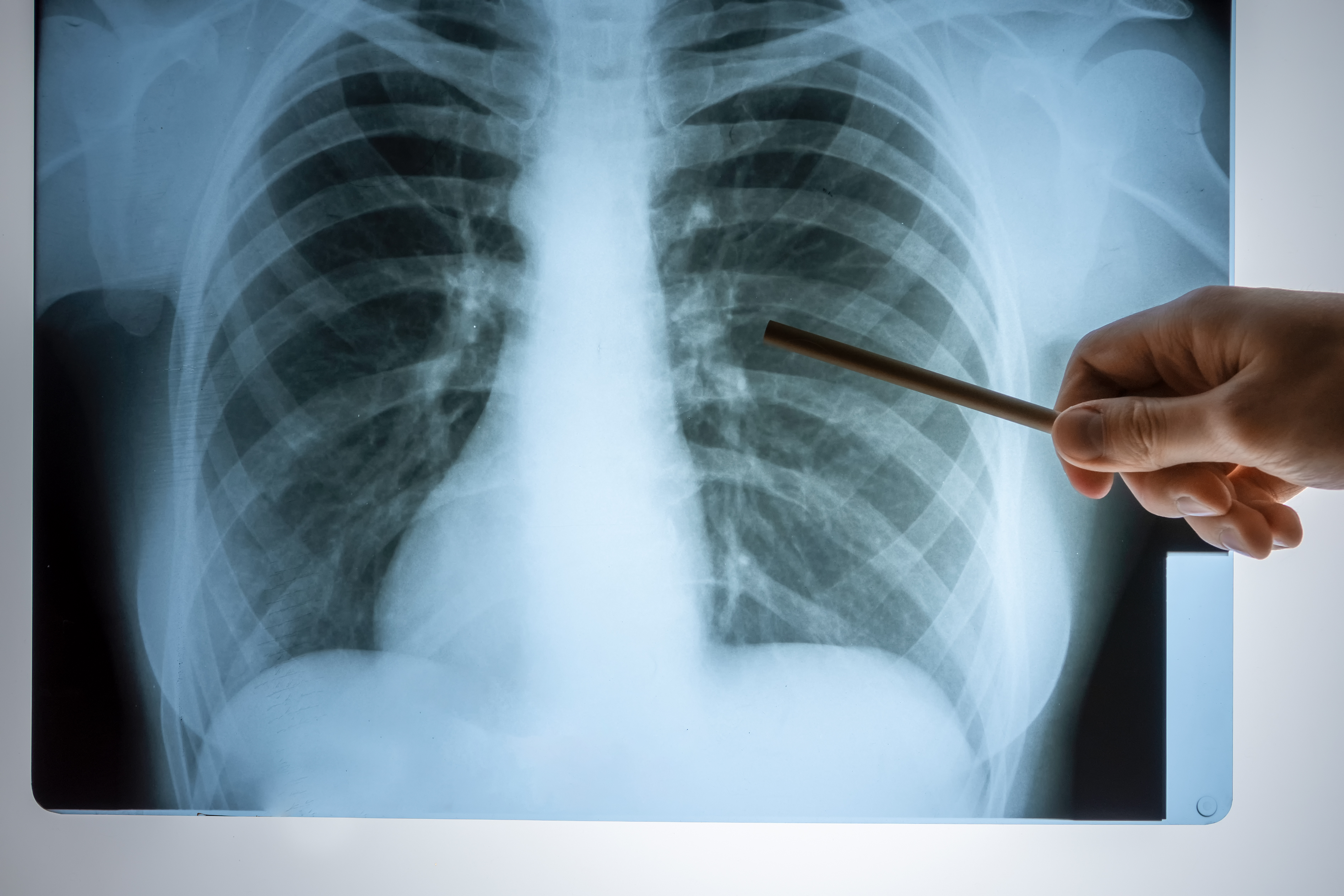 Indio High School Student Tests Positive for Tuberculosis; Riverside County Officials Launch Screening Effort