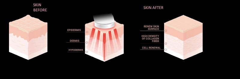 Photo 3 of PERFECTIO X LIGHT THERAPY DELIVERS ENERGY BACK INTO SKIN WHILE REMOVING UNWANTED AGING IN ALL THREE LAYERS OF SKIN NEW IN BOX
$7999
