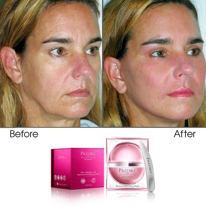 Photo 4 of COLLAGEN RENEWAL DETOXIFYING MASK TREATS WRINKLES AGE DEFYING AND CHRONIC SKIN DISEASES PROTECTS AGAINST ACNE PSORIASIS ECZEMA AND HIDRADENITIS UNLOCKING CLEAR  IRRESISTIBLE COMPLEXION NEW IN BOX $850
