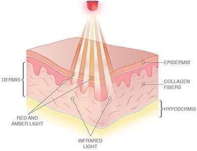 Photo 4 of 
INFRARED RED LED DEVICE PROMOTES THE PRODUCTION OF CELLS COLLAGEN FIBERS AND HAIR GROWTH FOR ALOPECIA TIGHTENS ANY STRETCHED SKIN IMPROVES SCARS WOUNDS ACNE PSORIASIS ROSACEA ECZEMA WRINKLES AND SUN DAMAGE NEW 
