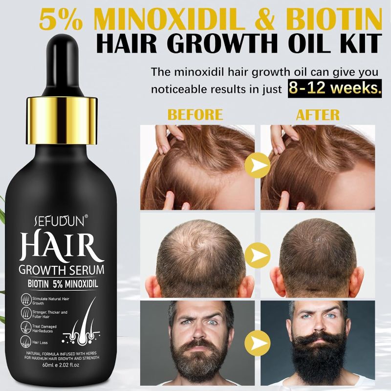 Photo 1 of 5% Minoxidil for Men and Women with Derma Roller, Hair Growth Serum & Beard Growth Kit, Minoxidil Biotin Hair Regrowth Treatment for Thicker, Fuller Hair - Stop Scalp Hair Loss & Thinning - 2.02 oz