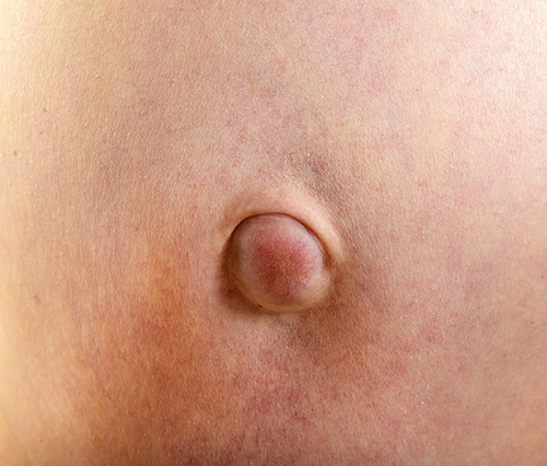 Hernia in adult