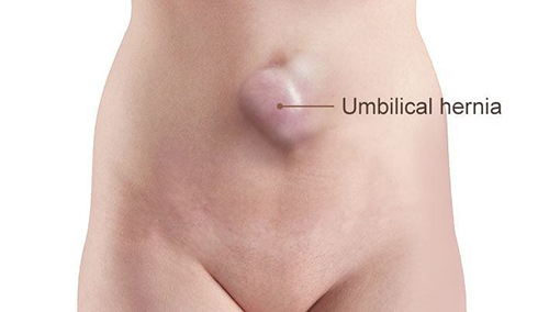 Image of umbilical hernia