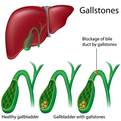 Bile duct blockage