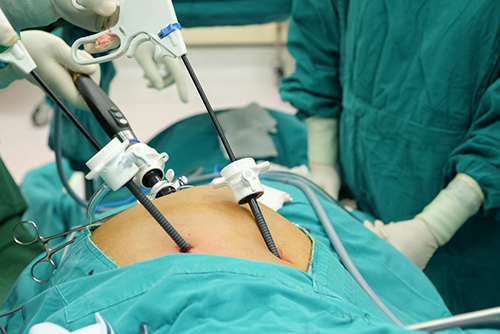 Laparoscopic surgery