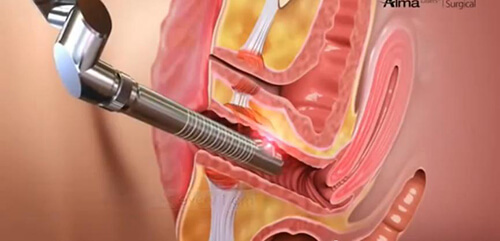 Vaginal Tightening Procedure