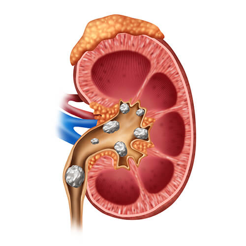  stones in Kidney 