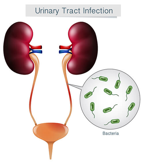 symptoms of a UTI