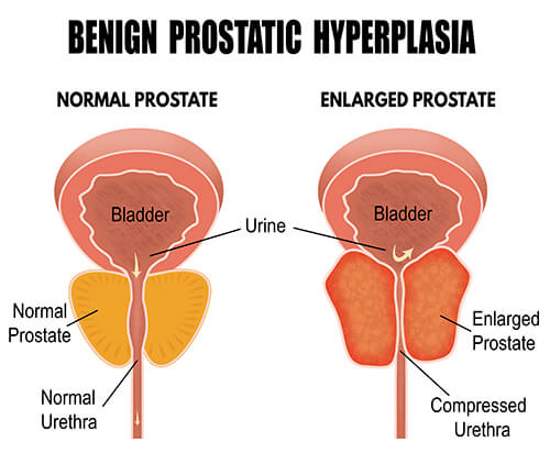 Urinary benign prostatic hyperplasia