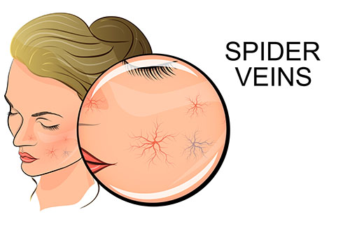 Spider veins