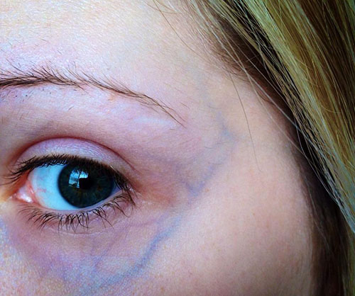 varicose veins eyes
