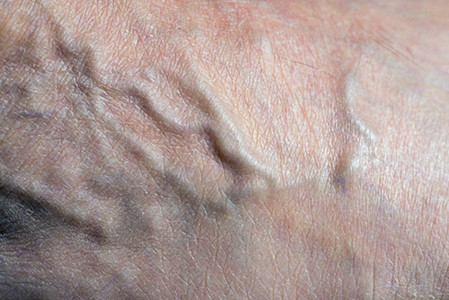 Varicose veins