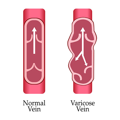Varicose hands