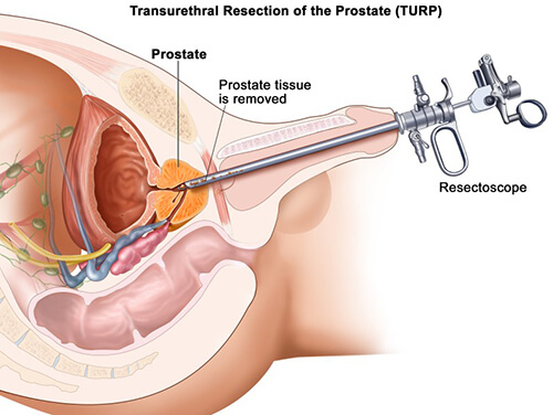 Transurethral resection