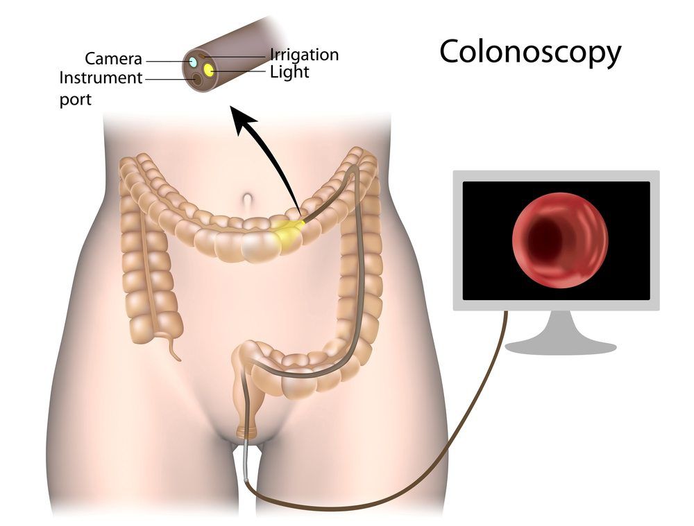 Colonoscopy