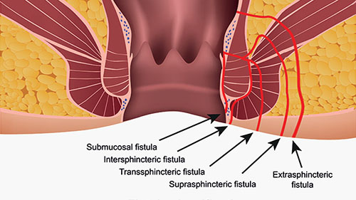 Types of Fistula