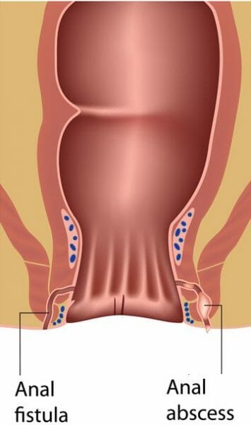 Fistula