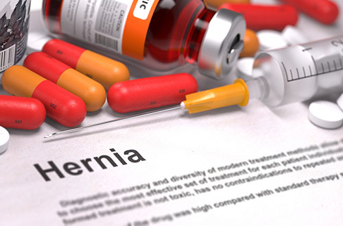 Facts About A Hernia