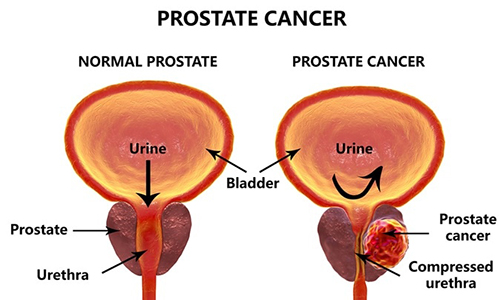 prostate cancer-adenocarcinoma
