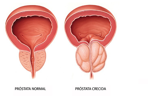 prostatitis- inflammation of the prostate gland