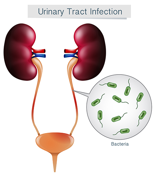 Urinary Tract Infection-UTI in males