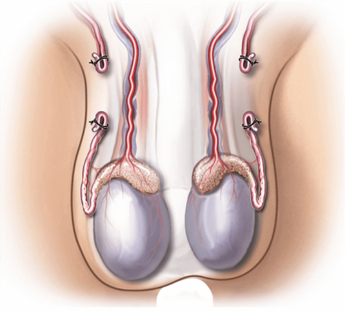 procedure for male sterilization-vasectomy