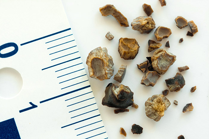 picture showing kidney stones