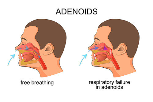 pictorial representation of adenoid