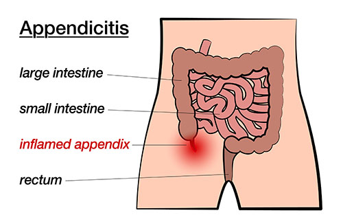 what is an appendictis