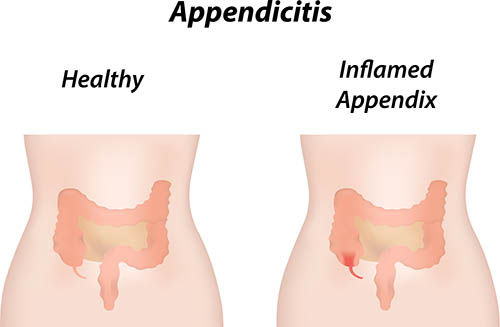 Appendicitis
