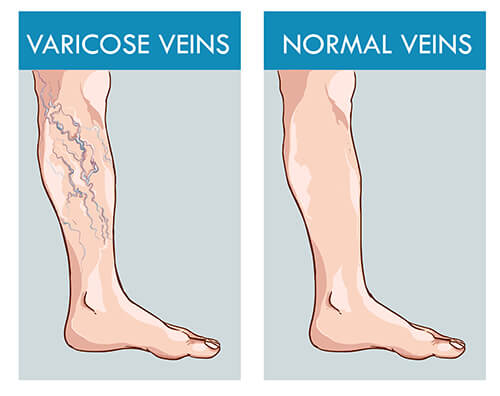 Varicose Veins