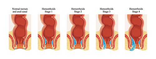Different Stages or Grades of Piles