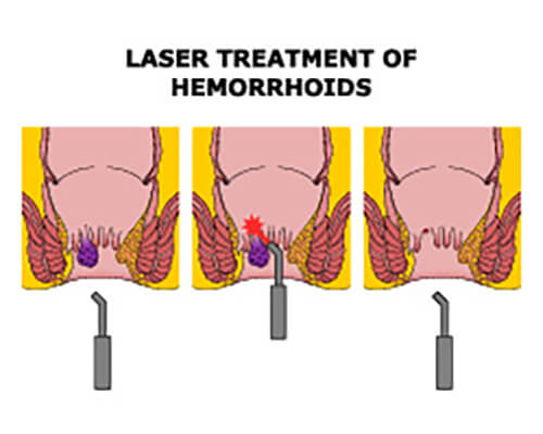 Laser-based Surgical Treatment