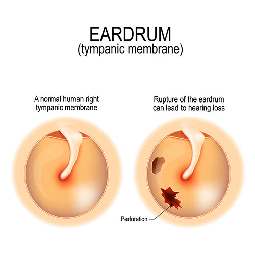 Difference between normal and ruptured tympanic membrane