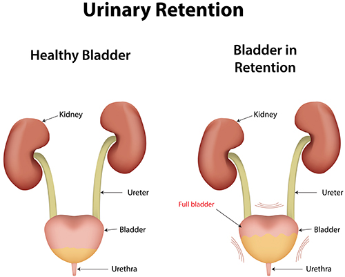 symptoms of urinary retention