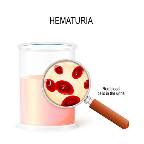 causes of hematuria