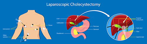 Cholecystectomy laparoscopic surgery
