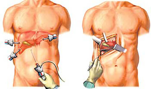 long incision in the abdomen