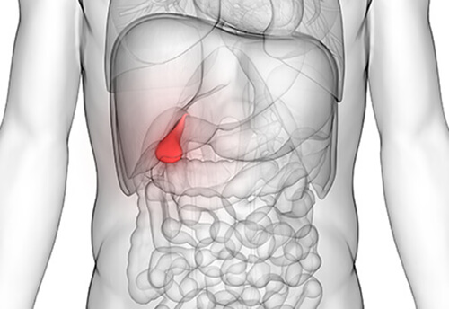 Cholecystitis